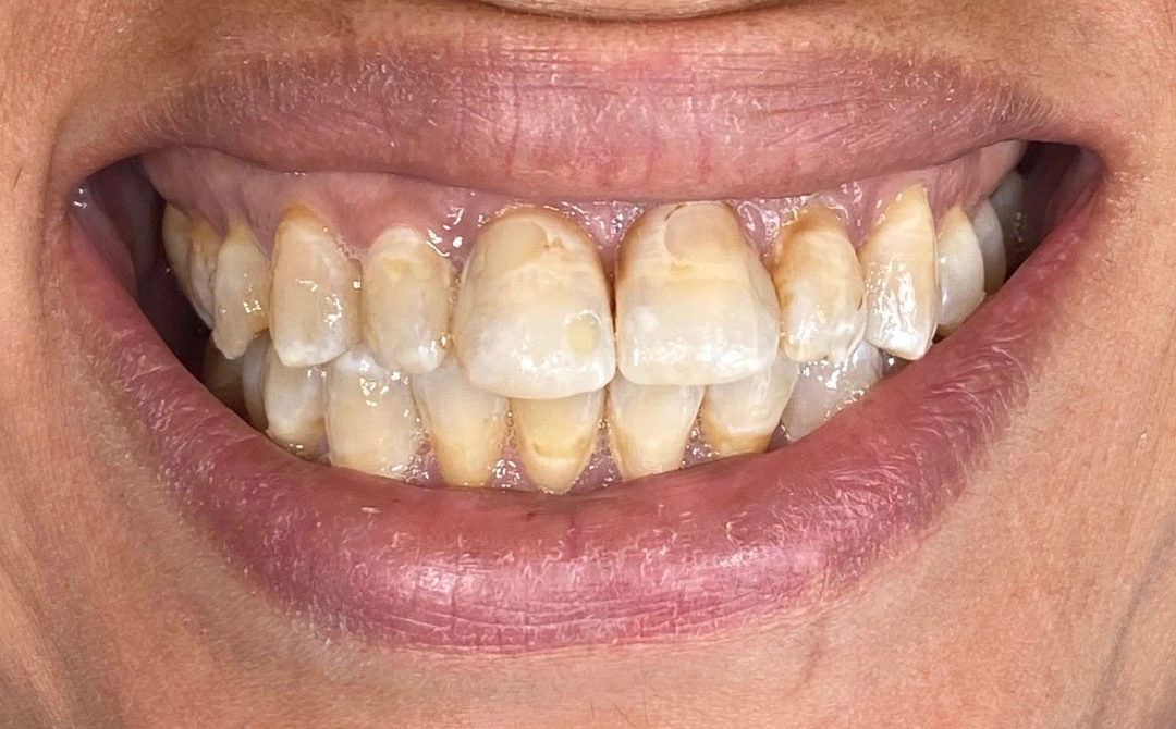 Faccette dentali