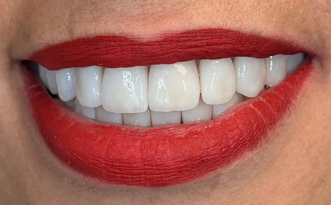 Faccette dentali