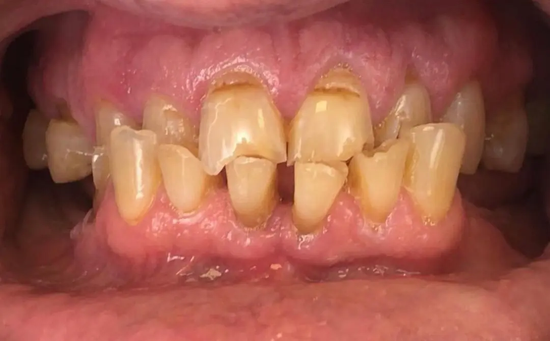 Faccette dentali