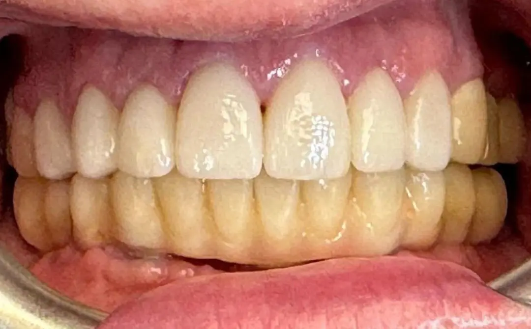 Faccette dentali