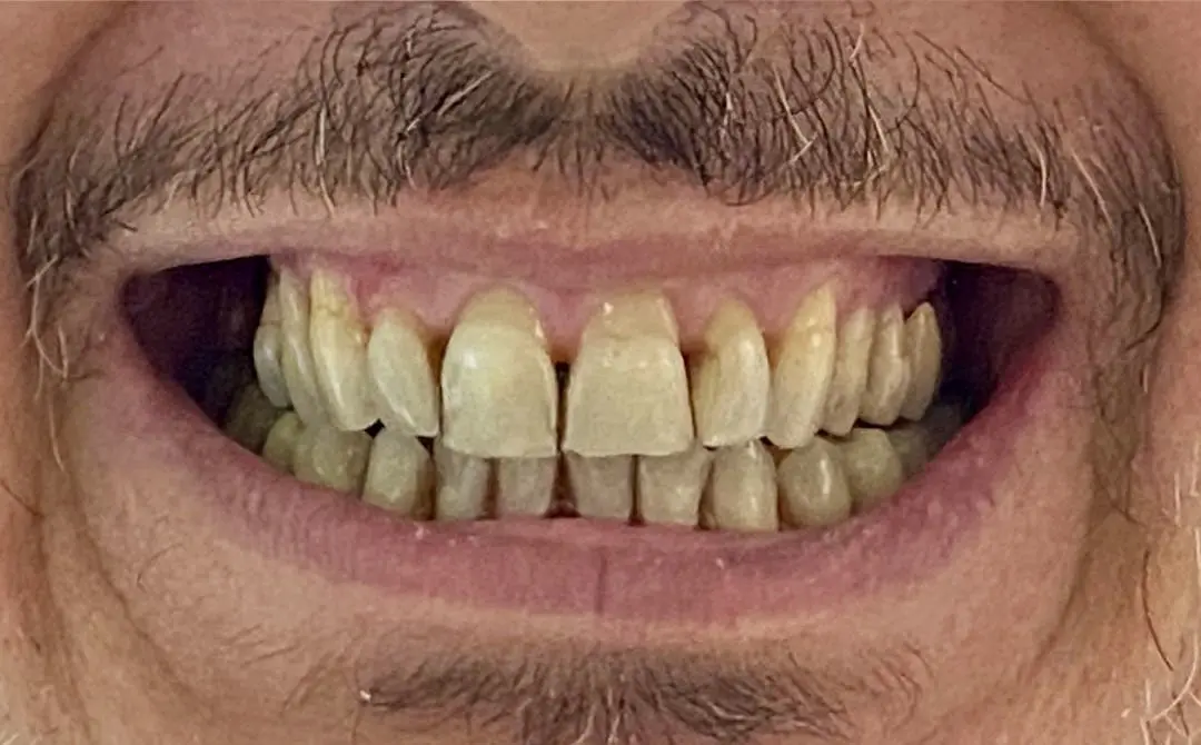 Faccette dentali