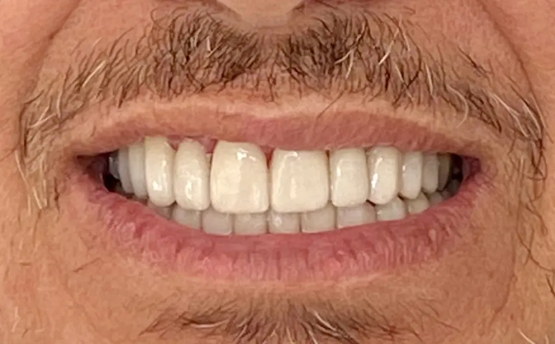 Faccette dentali