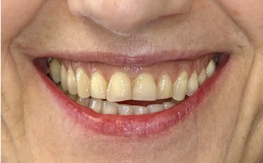 Faccette dentali