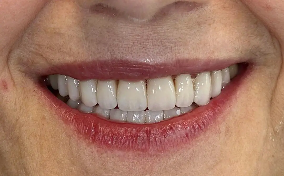 Faccette dentali