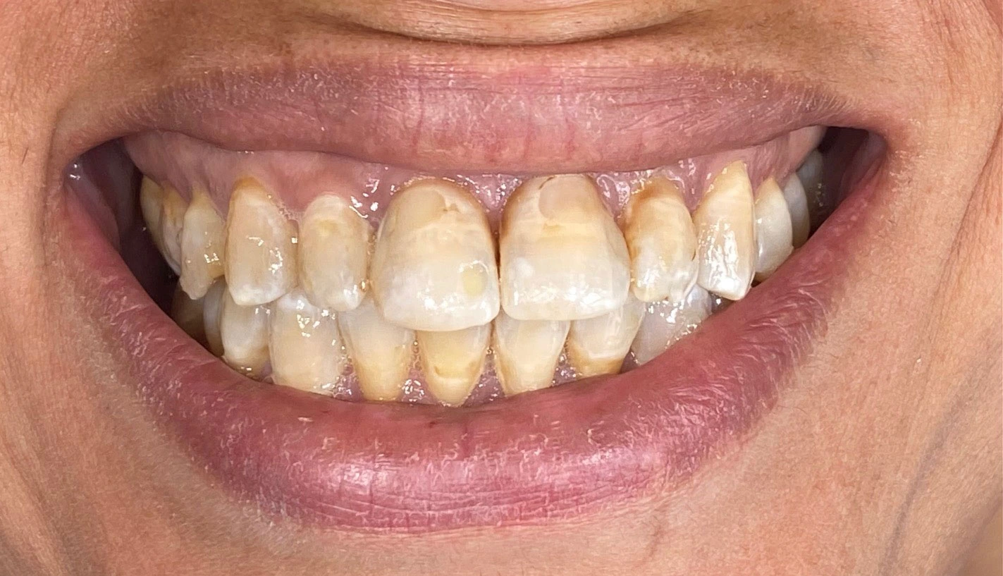 Faccette dentali