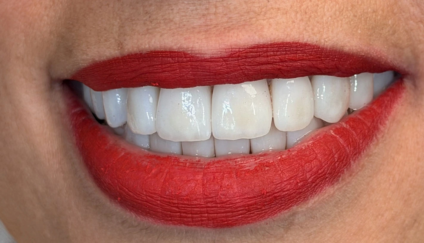 Faccette dentali